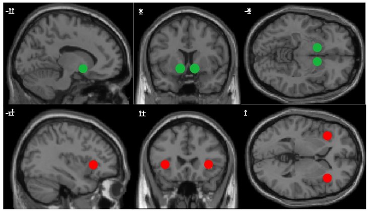 Figure 01: The main brain areas involved in risky decision-making. Ventral striatum (VS, green) and anterior insula (AI, red).